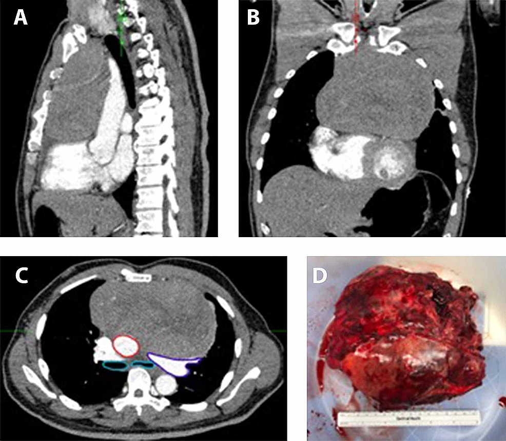 Anesthetic Management Of Resection Of A Large Anterior Mediastinal ...