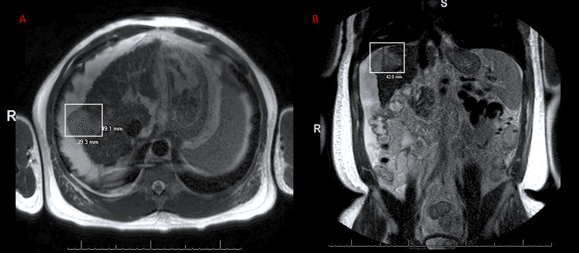 Cureus The Role of Hepatocellular Carcinoma Surveillance in