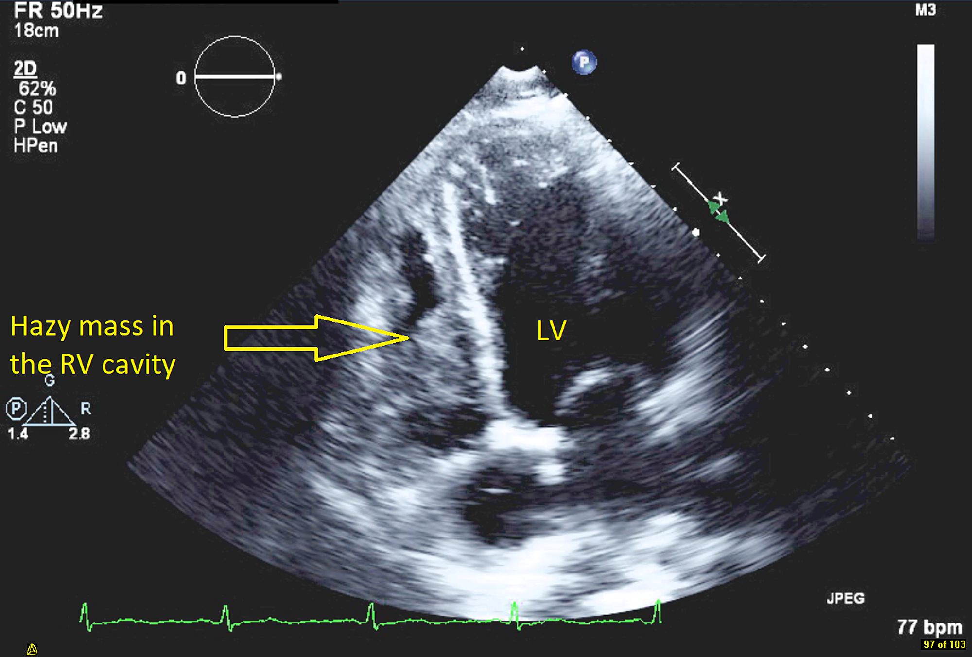 Cureus Infected Right Ventricle Thrombus as a Cause of Persistent Sepsis