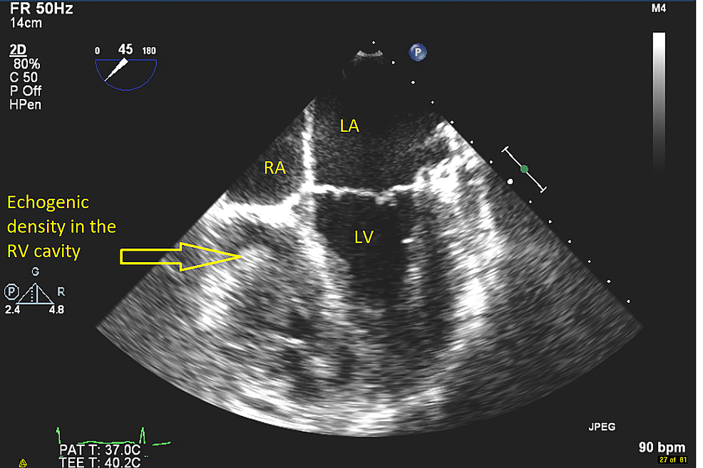 Cureus | Infected Right Ventricle Thrombus as a Cause of Persistent Sepsis