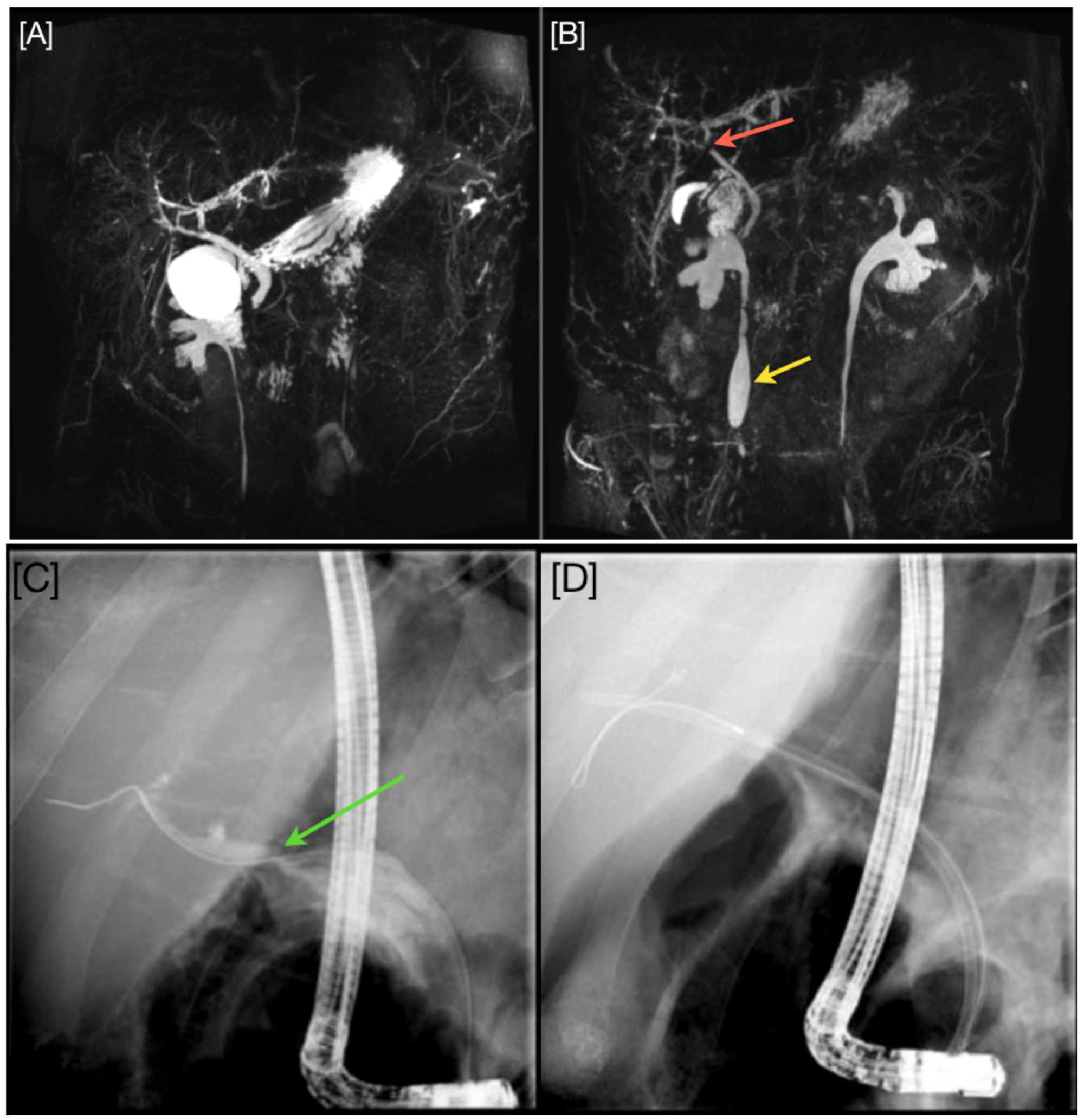 Cureus | Persistent Ketamine-Induced Cholangiopathy: An Approach To ...