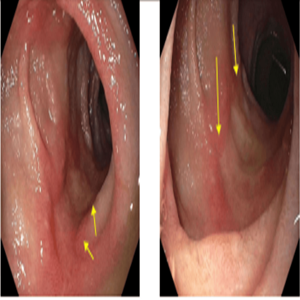 Upper-endoscopy-images-showing-four-cratered,-non-bleeding-duodenal-ulcers-with-a-clean-ulcer-base-(Forrest-Class-III).
