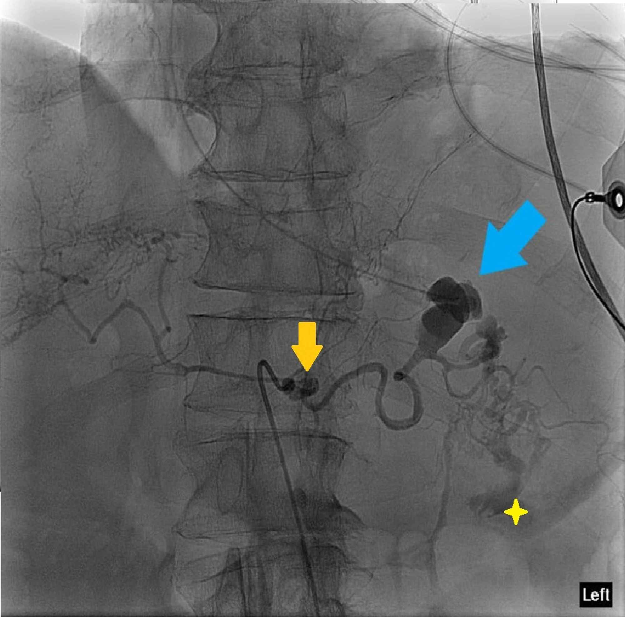 Cureus Acute Gastric Hemorrhage Due To Gastric Cancer Eroding Into A Splenic Artery Pseudoaneurysm Two Dangerously Rare Etiologies Of Upper Gastrointestinal Bleeding