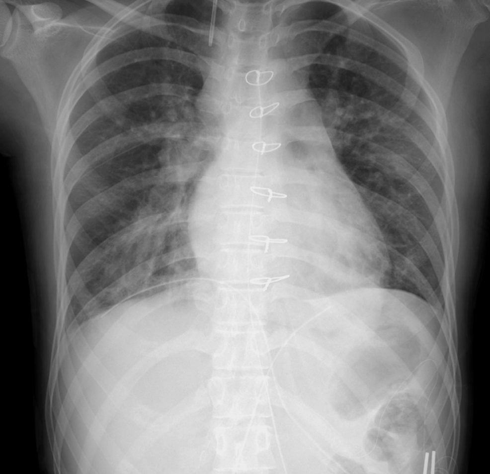 Chest-radiograph-obtained-before-extubation