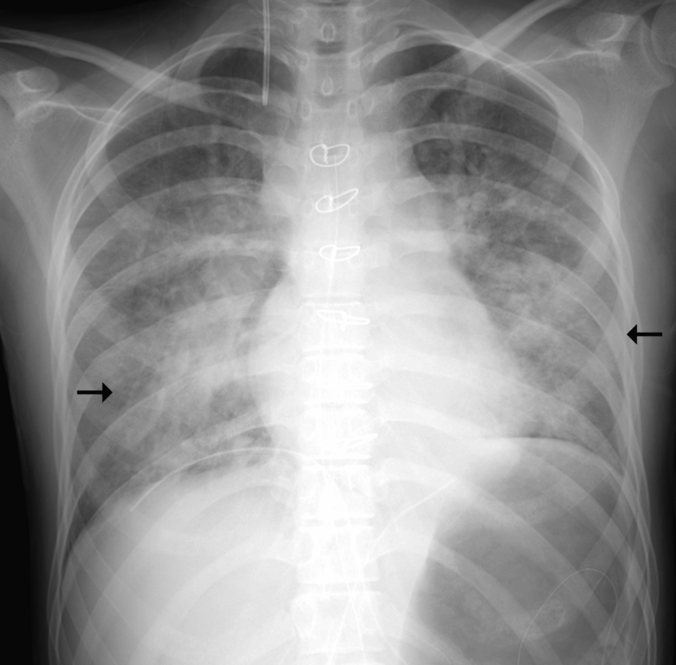Chest-radiograph-obtained-after-aspiration-showed-diffuse-bilateral-consolidation-(arrows)