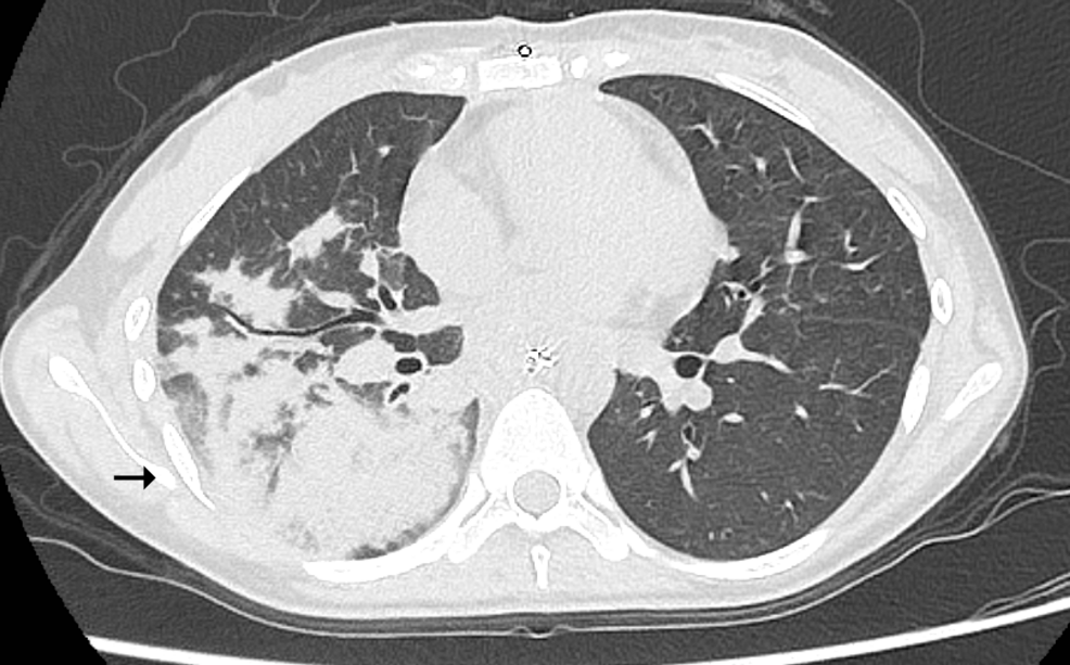 Computed-tomography-(CT)-scan-obtained-after-reintubation-revealed-massive-consolidation-predominantly-in-the-right-lower-lobe-(arrow)