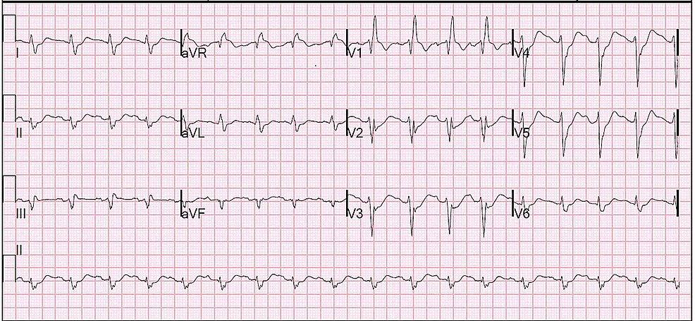 Cureus | Protamine-Induced Bradycardic Arrest in a Diabetic Patient