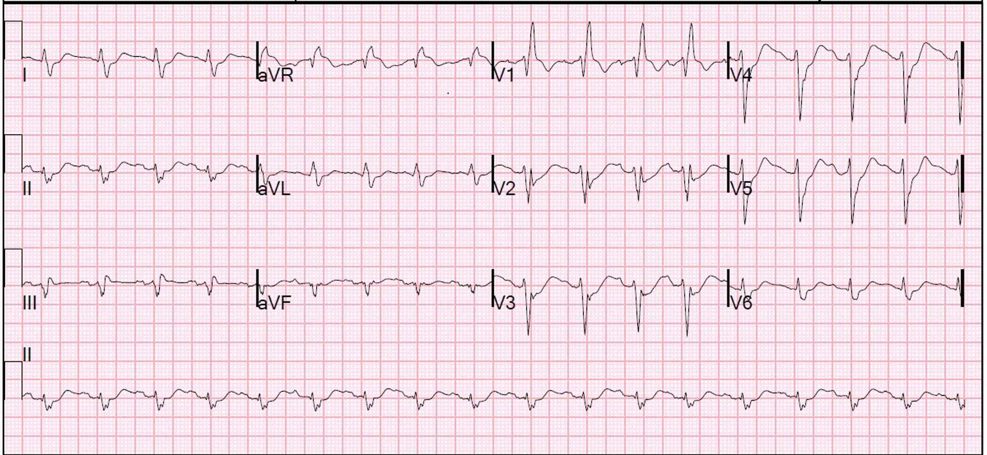 Cureus | Protamine-Induced Bradycardic Arrest in a Diabetic Patient