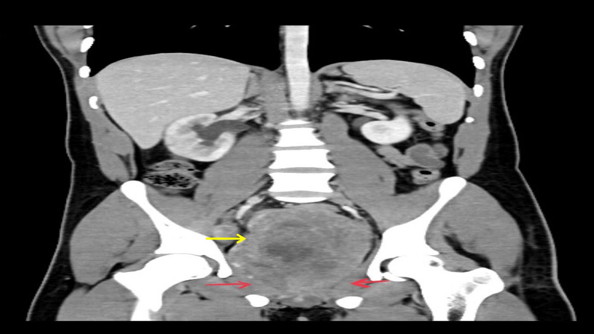 Cureus Testicular Torsion In A Rare Case Of Prostatic Spindle Cell Rhabdomyosarcoma 0009