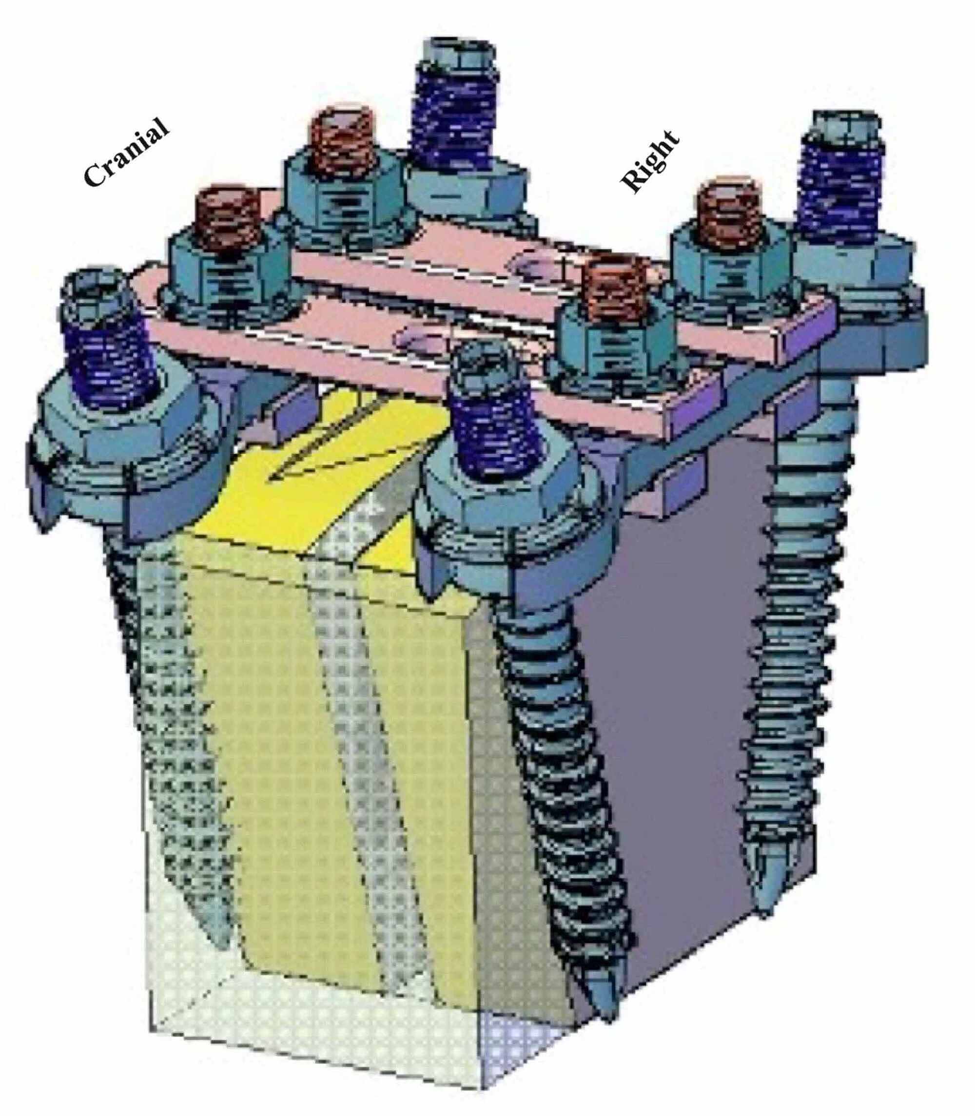 Cureus A Novel Plate Based System Unimax For Posterior Instrumented