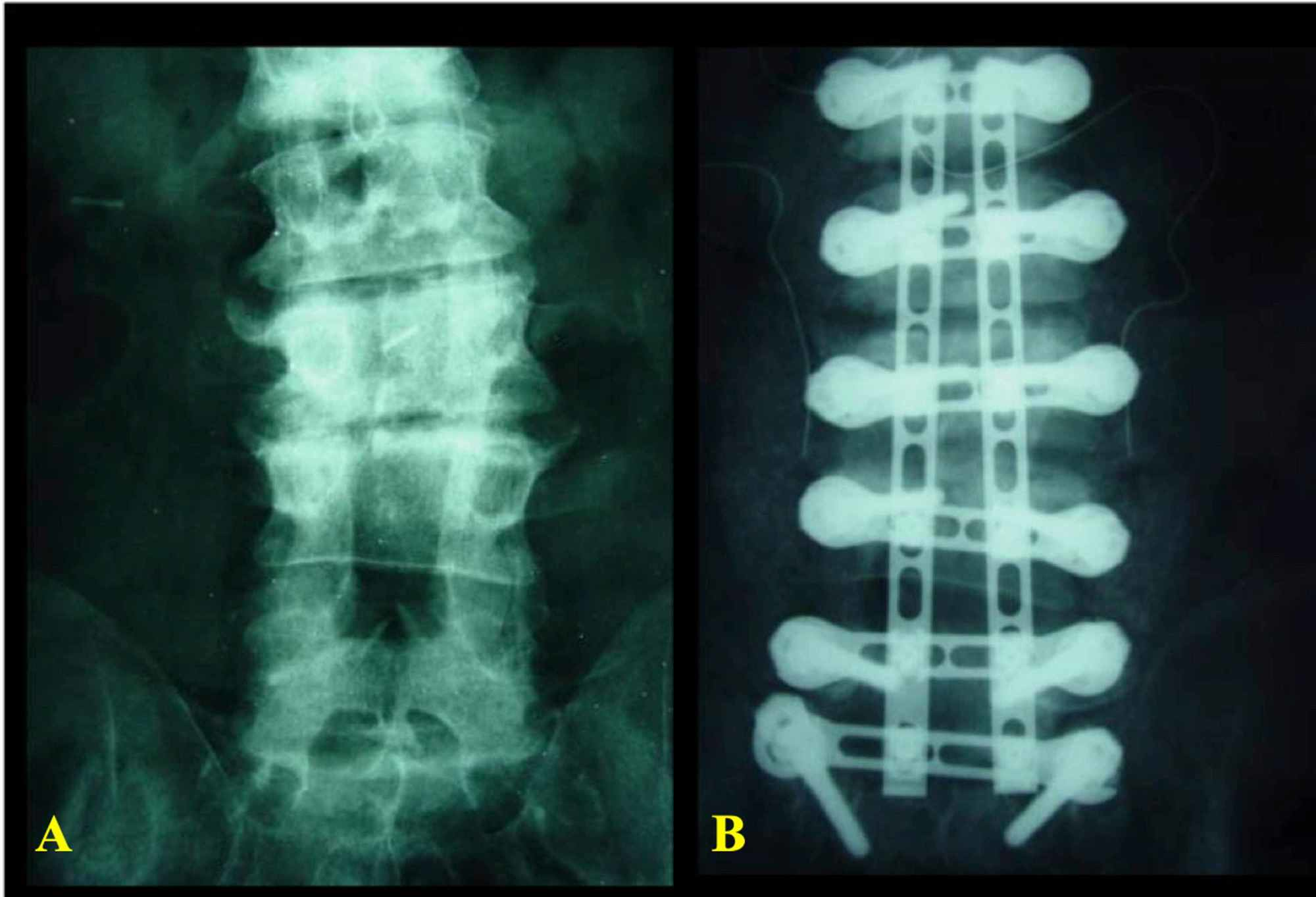 Cureus A Novel Plate Based System Unimax For Posterior Instrumented