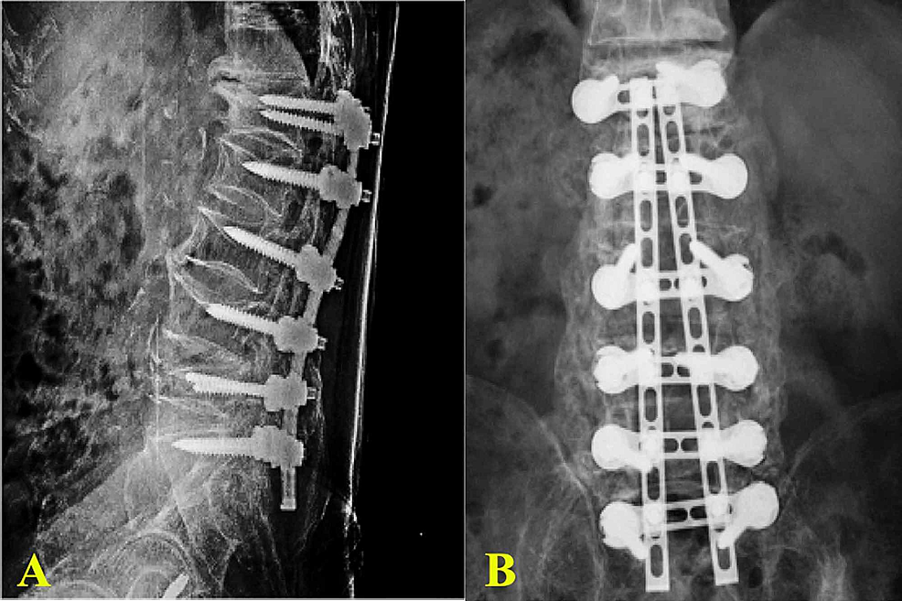 Cureus | A Novel Plate-Based System (UNIMAX) for Posterior Instrumented