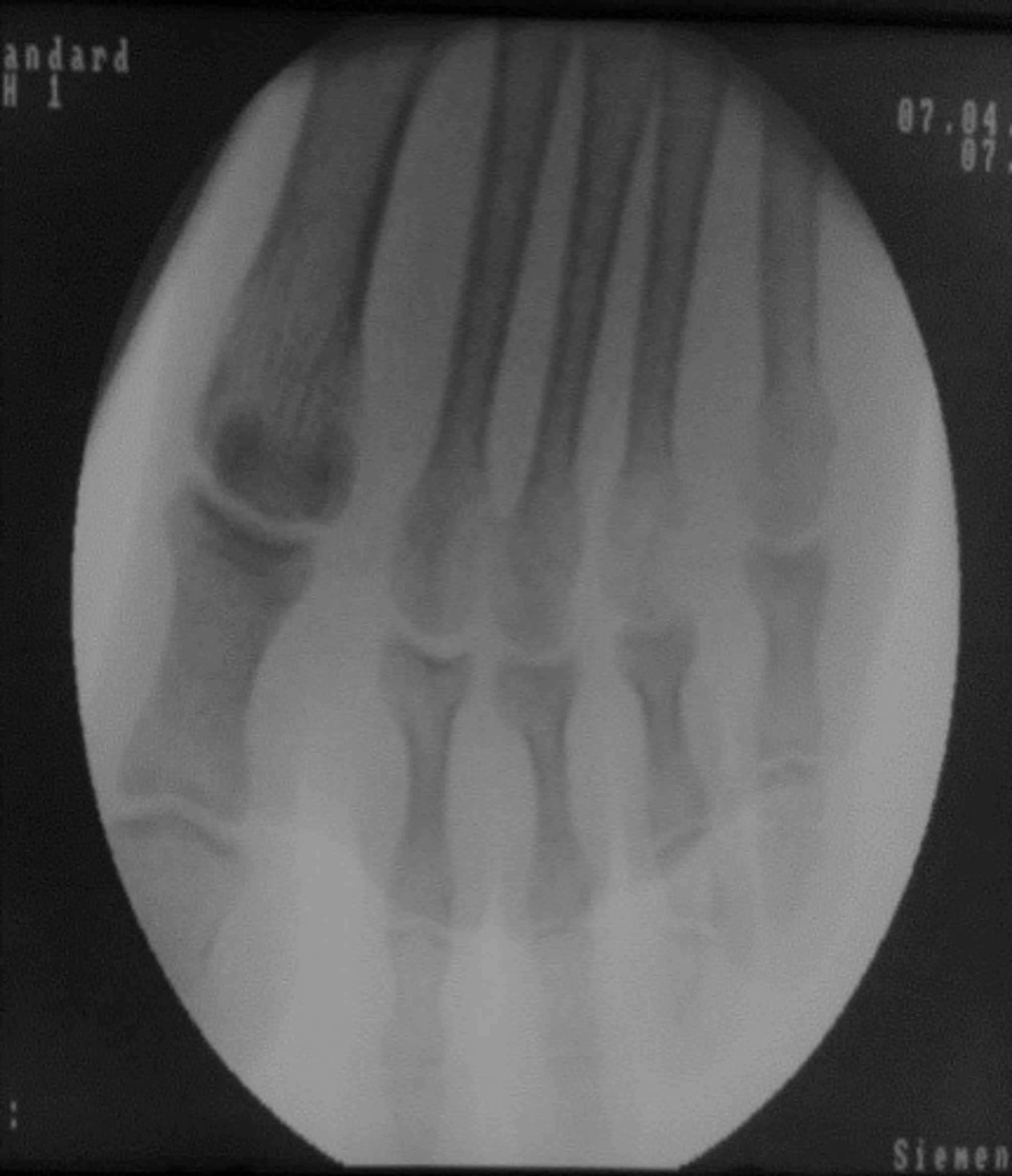 cpt orif 5th metatarsal fracture cpt orif 5th metatarsal fracture