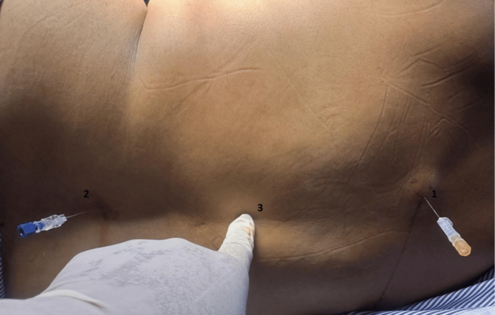 Spinal-anesthesia-at-two-levels-(1-and-2)-and-fracture-site-(3)