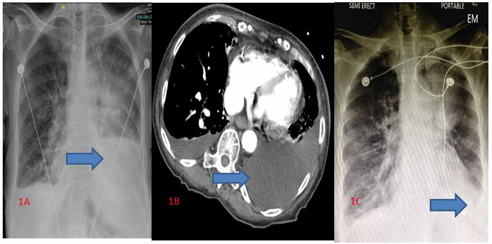 Cureus Isolated Left Atrial Cardiac Tamponade Caused By Pleural Hot