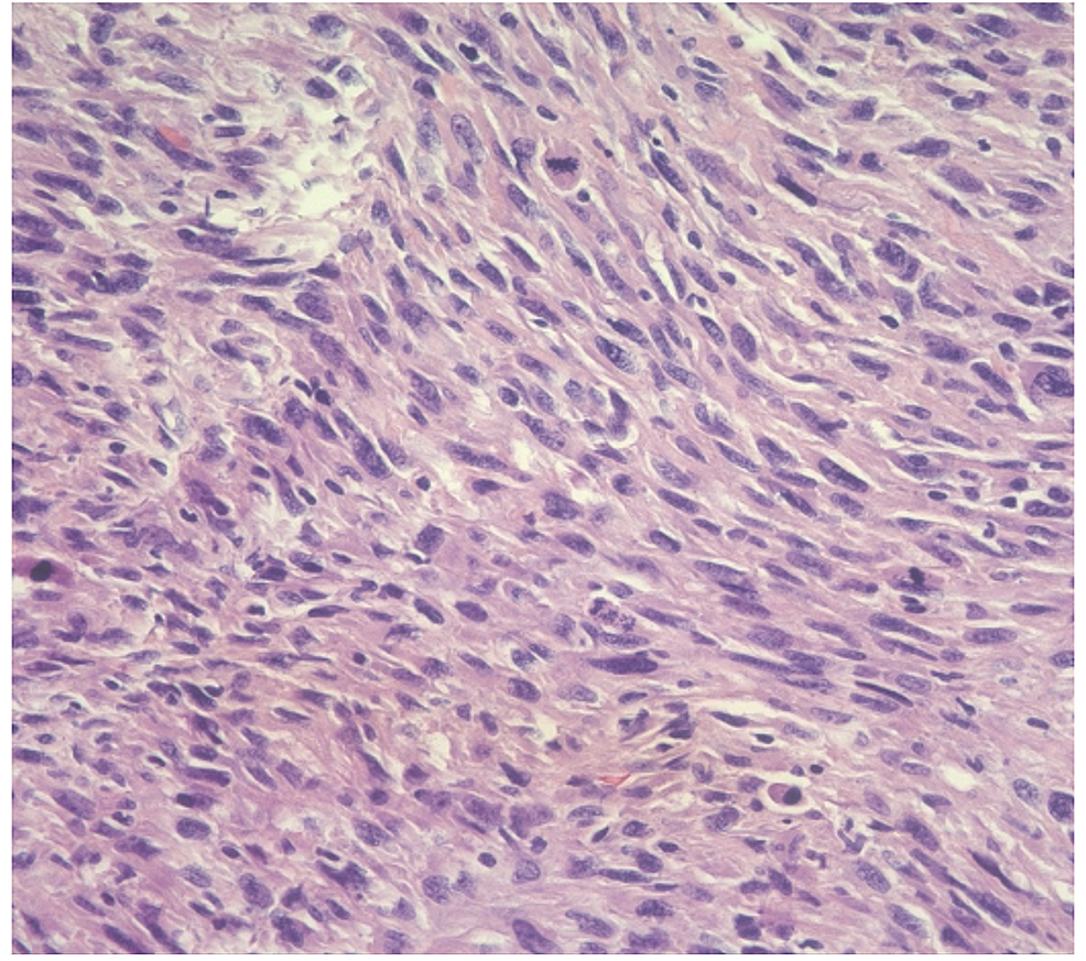 Cureus | Primary Leiomyosarcoma of the Mesentery: A Case Report With ...