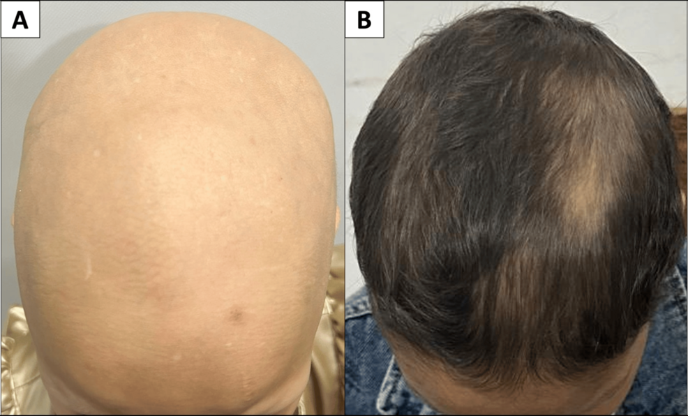 Efficacy and Safety of Oral Betamethasone Mini-Pulses in Moderate to Severe Alopecia  Areata