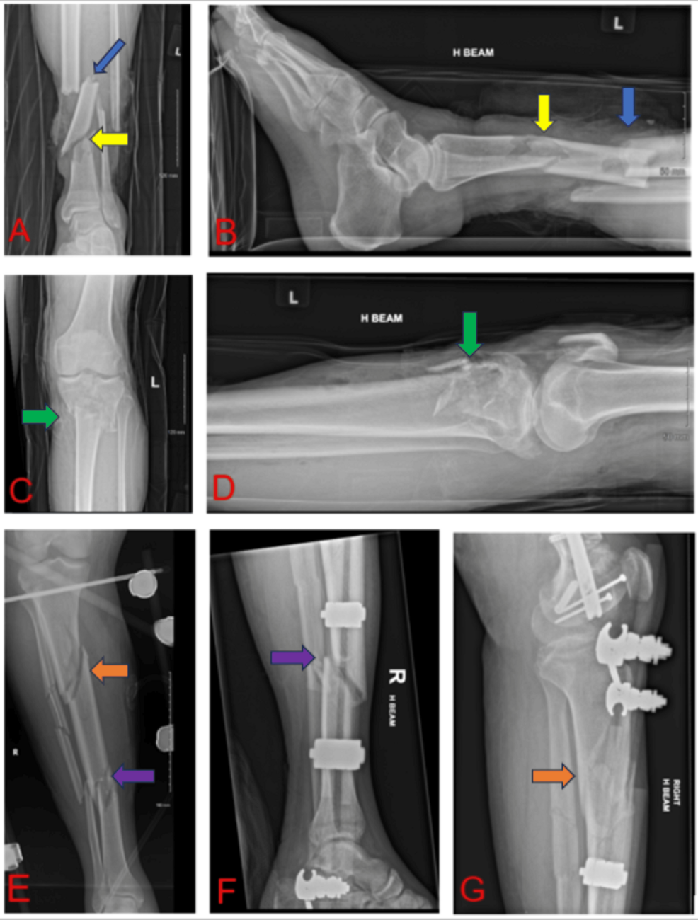 Application of a Double- and Triple-Stacked Hexapod (Taylor Spatial Frame)  for High-Energy Segmental Tibial Fractures | Cureus, image size:986x1300
