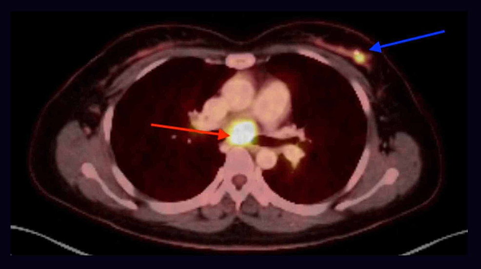 Cureus | Novel Presentation of Pulmonary Atypical Carcinoid Tumor as ...