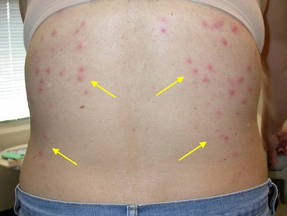 Pseudomonas Dermatitis Pictures