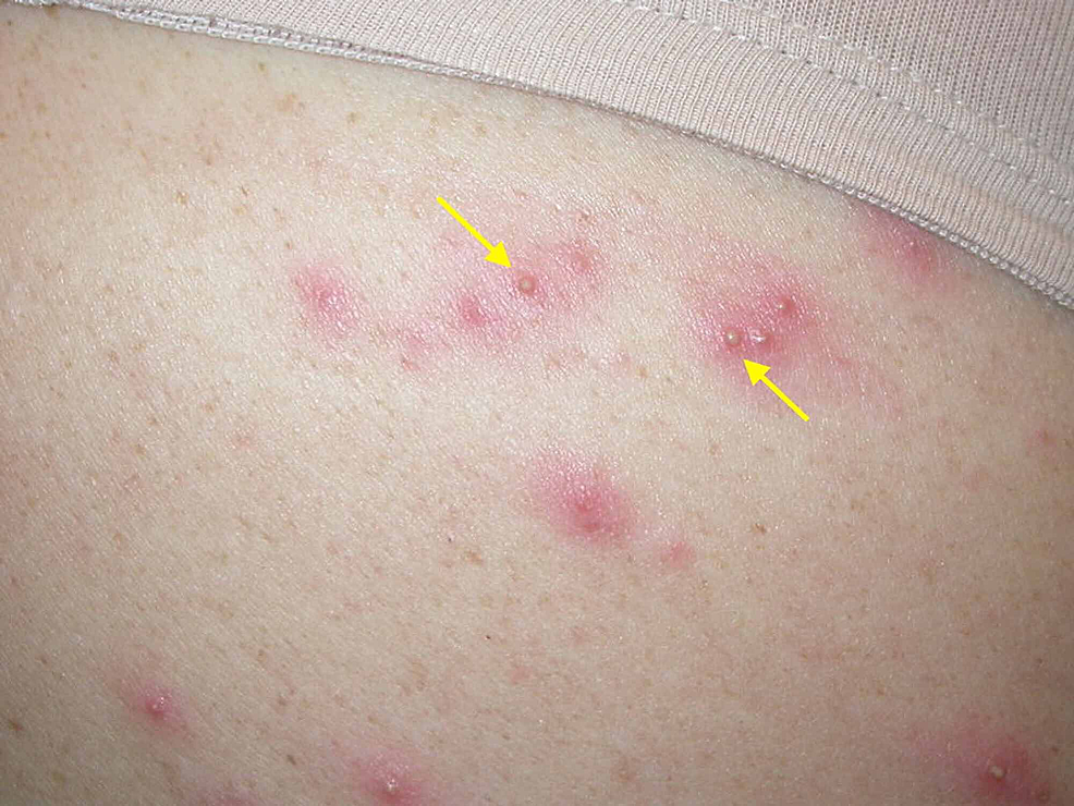 Cureus Hot Tub Associated Pseudomonas Folliculitis A Case Report And