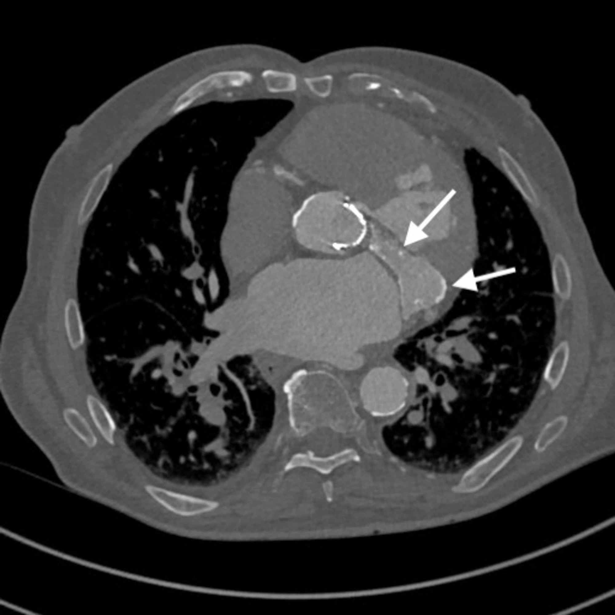 Cureus Mitral Regurgitation Due To Caseous Calcification Of The