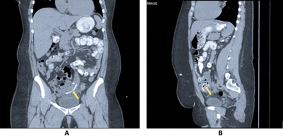 Abdomen/pelvis-CT-demonstrating-peritoneal-dialysis-catheter-appearing-to-be-located-within-the-lumen-of-the-small-bowel-(yellow-arrow,-A,-B).