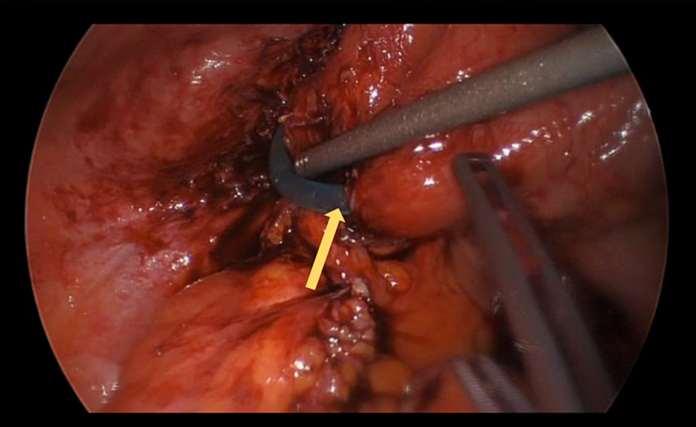 Site-of-catheter-tip-erosion-into-the-small-bowel-(yellow-arrow).