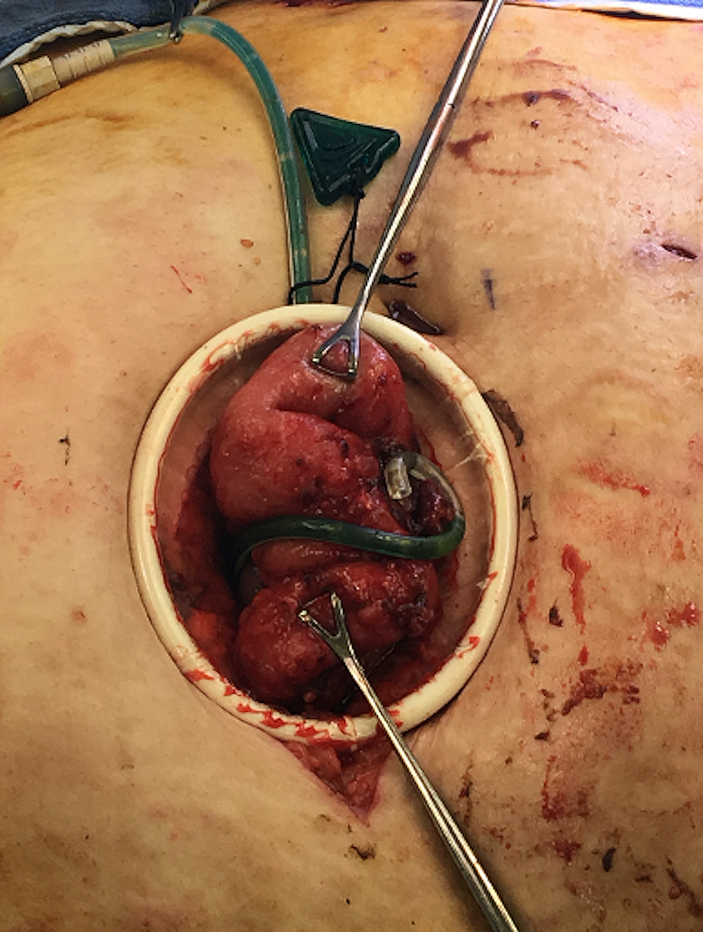 Exteriorization-of-the-eroded-catheter-and-affected-small-bowel-prior-to-removal,-resection-and-anastomosis.