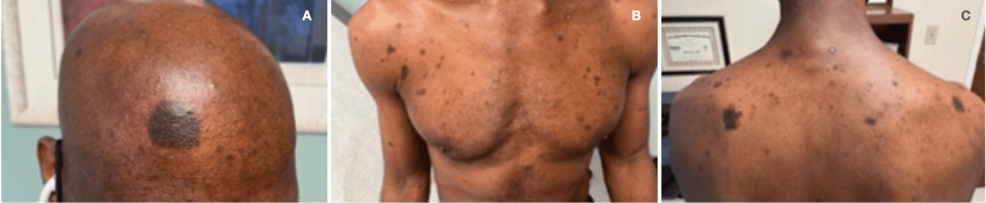 A:-Hyperpigmented-macular-lesions-in-forehead;-B:-chest-and-upper-extremities;-and-C:-upper-back. A:-Hyperpigmented-macular-lesions-in-forehead;-B:-chest-and-upper-extremities;-and-C:-upper-back.