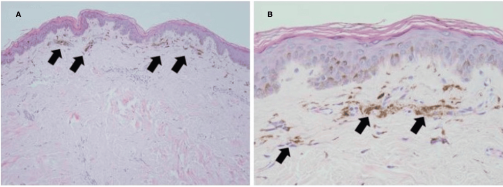 Skin-biopsy-histopathology.-A:-Low-power-magnification-of-melanin-pigment-accumulation-in-the-superficial-dermis-(arrows;-H&E-stain,-100x).-B:-High-power-magnification-of-dermal-melanophages-(melanin-containing-macrophages;-H&E-stain,-400x). Skin-biopsy-histopathology.-A:-Low-power-magnification-of-melanin-pigment-accumulation-in-the-superficial-dermis-(arrows;-H&E-stain,-100x).-B:-High-power-magnification-of-dermal-melanophages-(melanin-containing-macrophages;-H&E-stain,-400x).