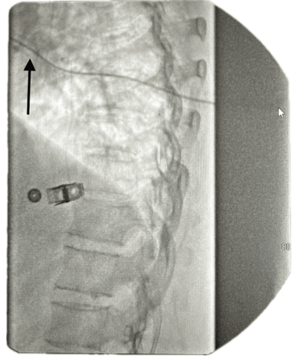 Lateral-lumbar-X-ray-view-demonstrating-intrathecal-catheter-tip-placement.-The-black-arrow-on-the-left-highlights-the-path-of-the-catheter-extending-toward-the-spinal-canal. Lateral-lumbar-X-ray-view-demonstrating-intrathecal-catheter-tip-placement.-The-black-arrow-on-the-left-highlights-the-path-of-the-catheter-extending-toward-the-spinal-canal.