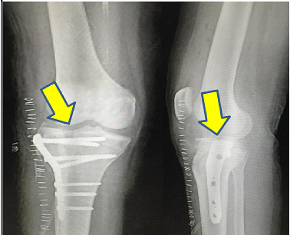 Plain-radiograph-(anteroposterior-and-lateral-view)-of-the-right-knee-showing-reduced-split-fracture-involving-the-lateral-tibial-condyle-with-locking-compression-plate.