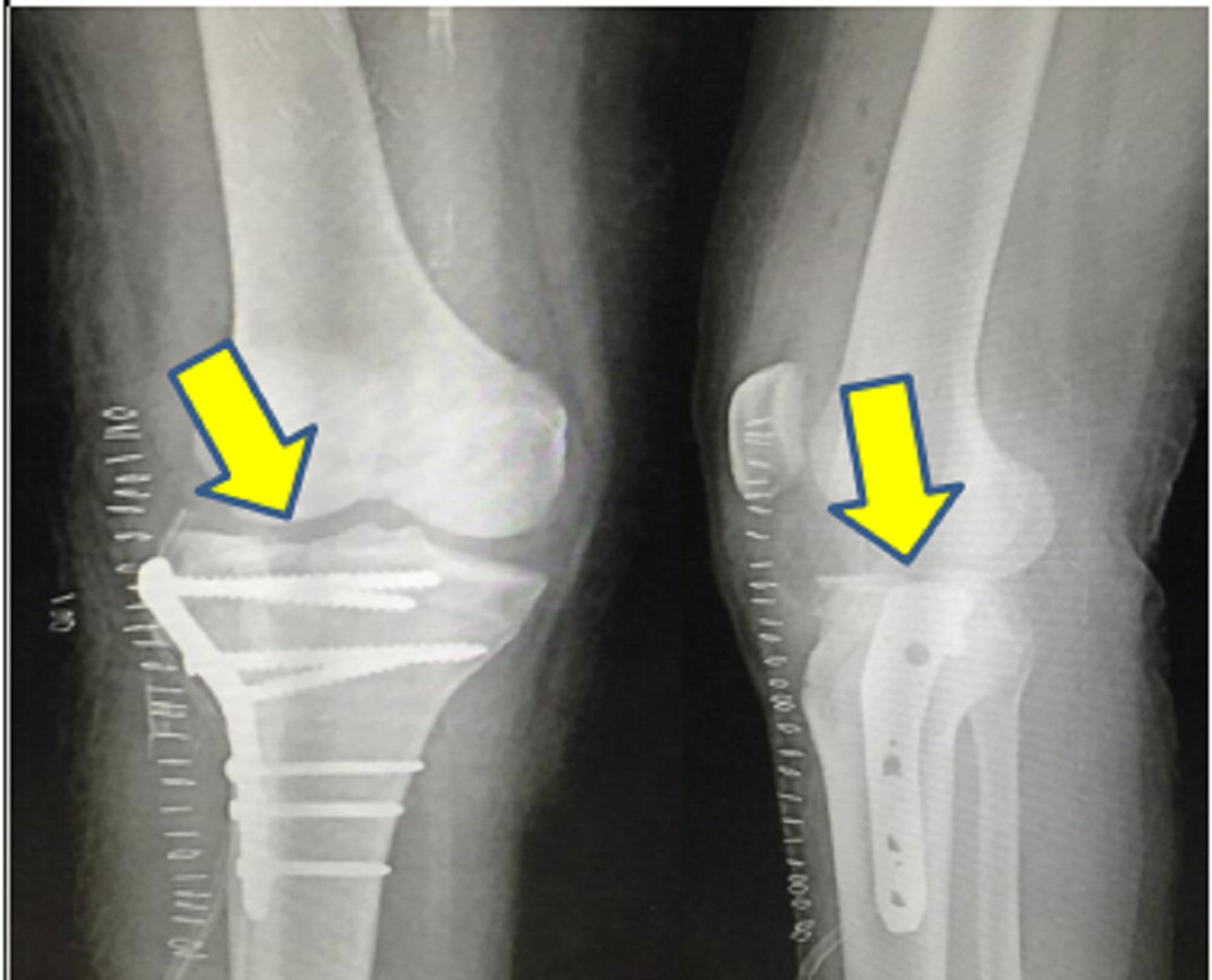 tibial plateau fracture orthobullets