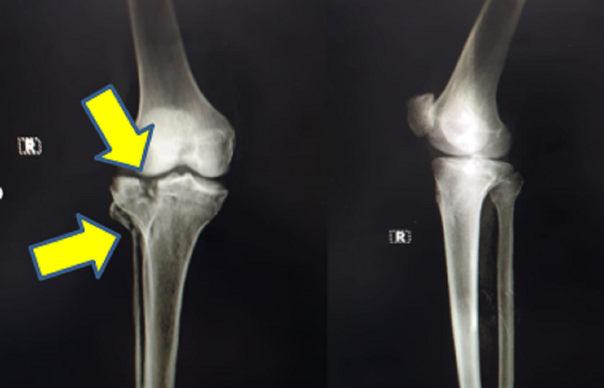 Cureus Unusual Good Functional Outcome After Surgical Management Of Maluniting Schatzker Type Ii Fracture