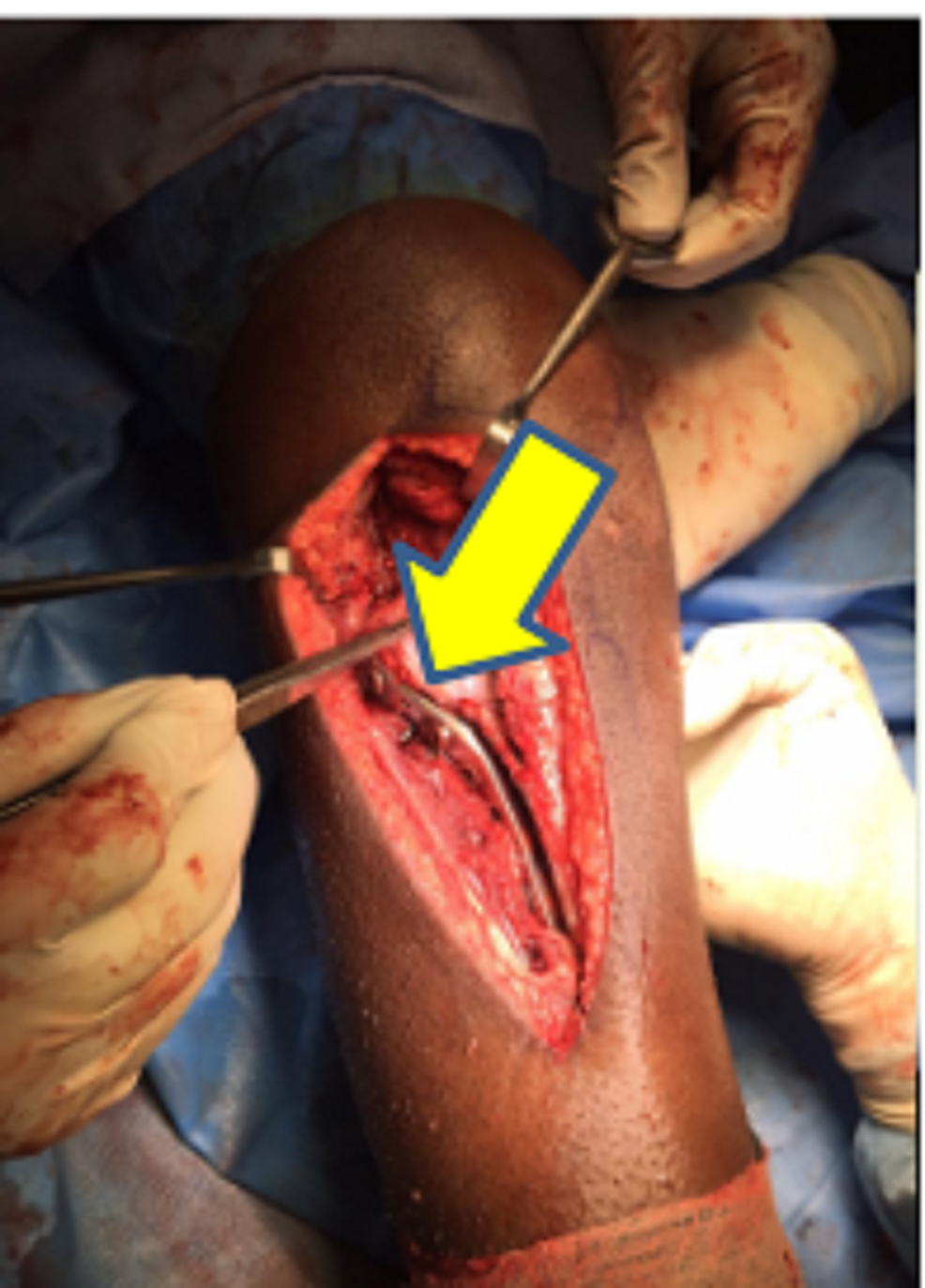 Intra-operative-picture-showing-high-grade-tear-in-the-proximal-aspect-of-the-lateral-collateral-ligament-and-grade-2-medial-collateral-ligament-tear,-which-was-treated-with-open-reduction-and-internal-fixation-with-proximal-tibia-locking-compression-plating-with-autologous-bone-grafting-from-the-ipsilateral-iliac-crest.
