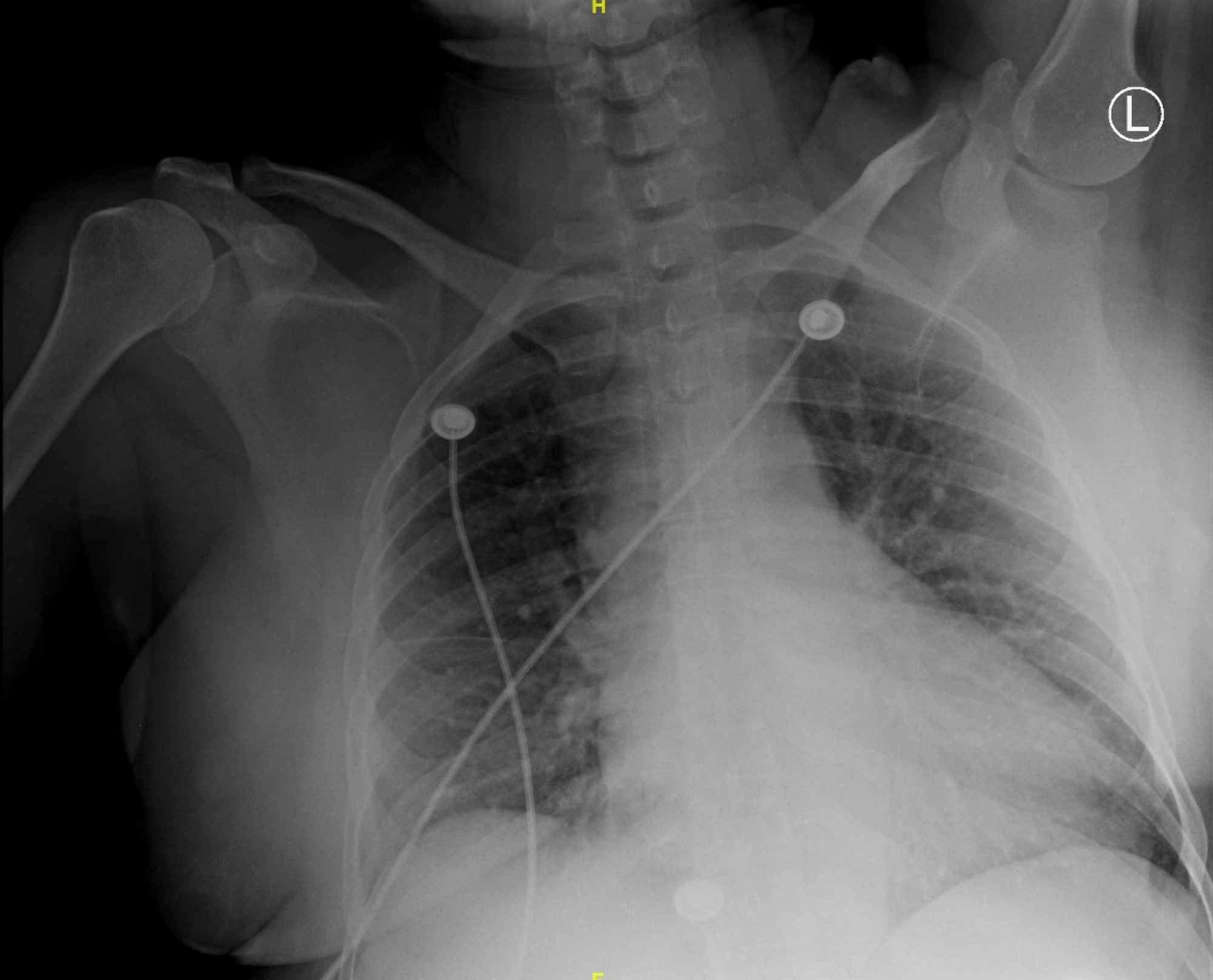 Cureus NaltrexoneAssociated NonSTElevated Myocardial Infarction