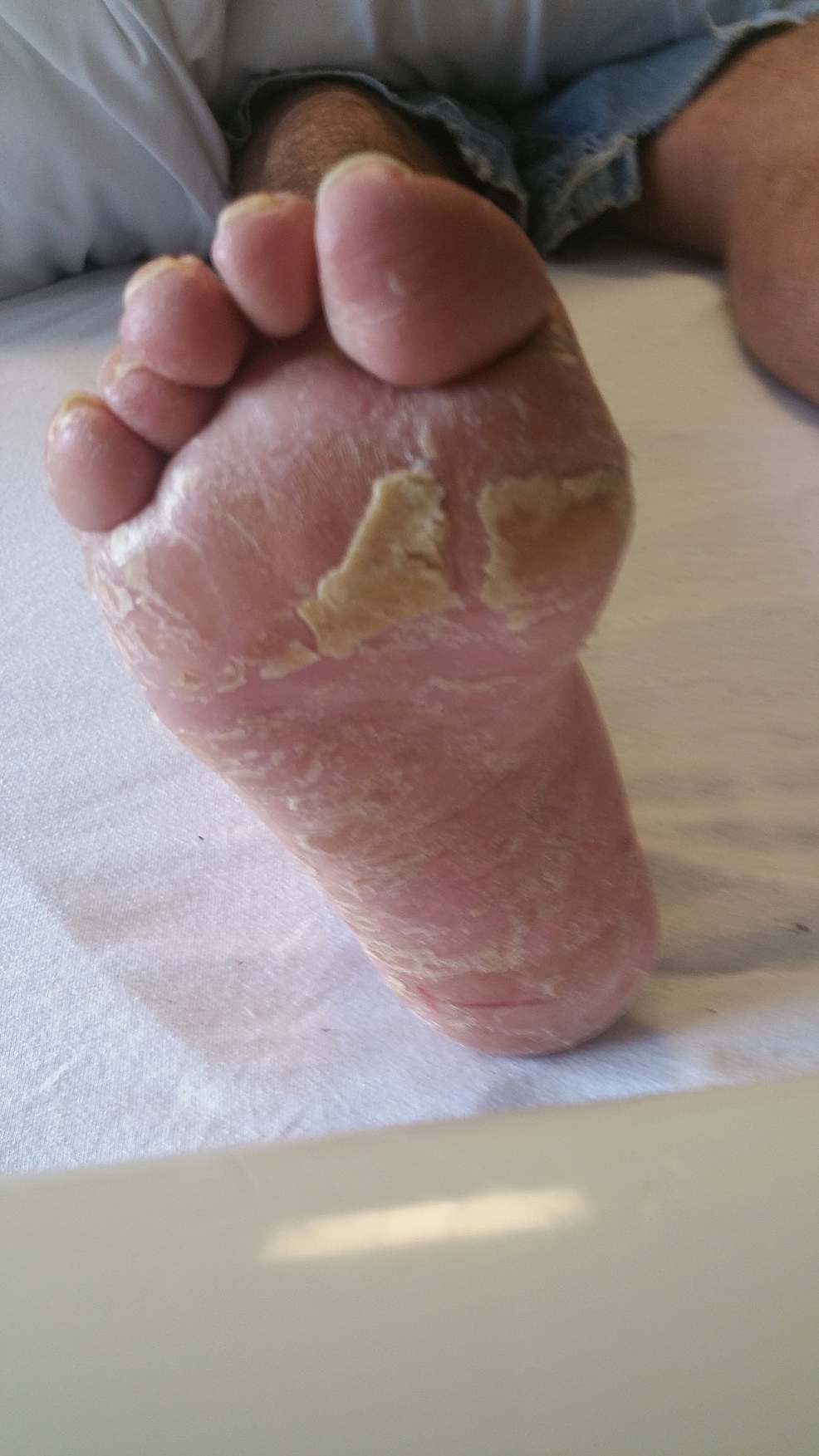 Exfoliation-and-inflammation-of-right-foot.