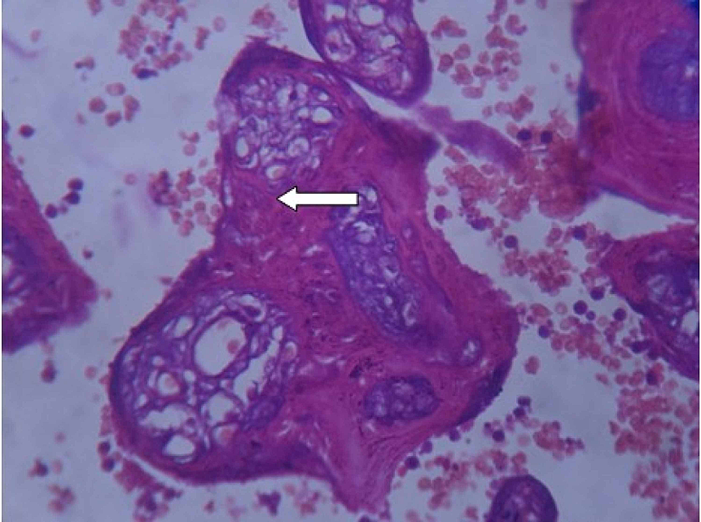 Cureus | An Objective Histopathological Scoring System For Placental ...