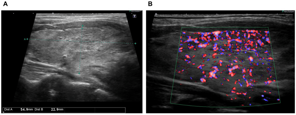 Thyroid-ultrasound-findings. Thyroid-ultrasound-findings.