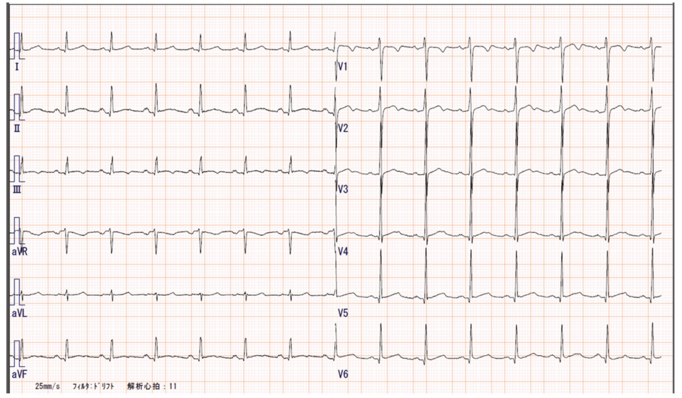 12-lead-electrocardiogram. 12-lead-electrocardiogram.