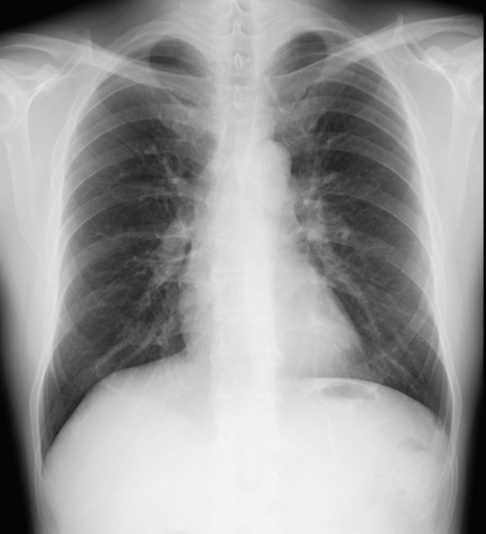 Chest-X-ray. Chest-X-ray.