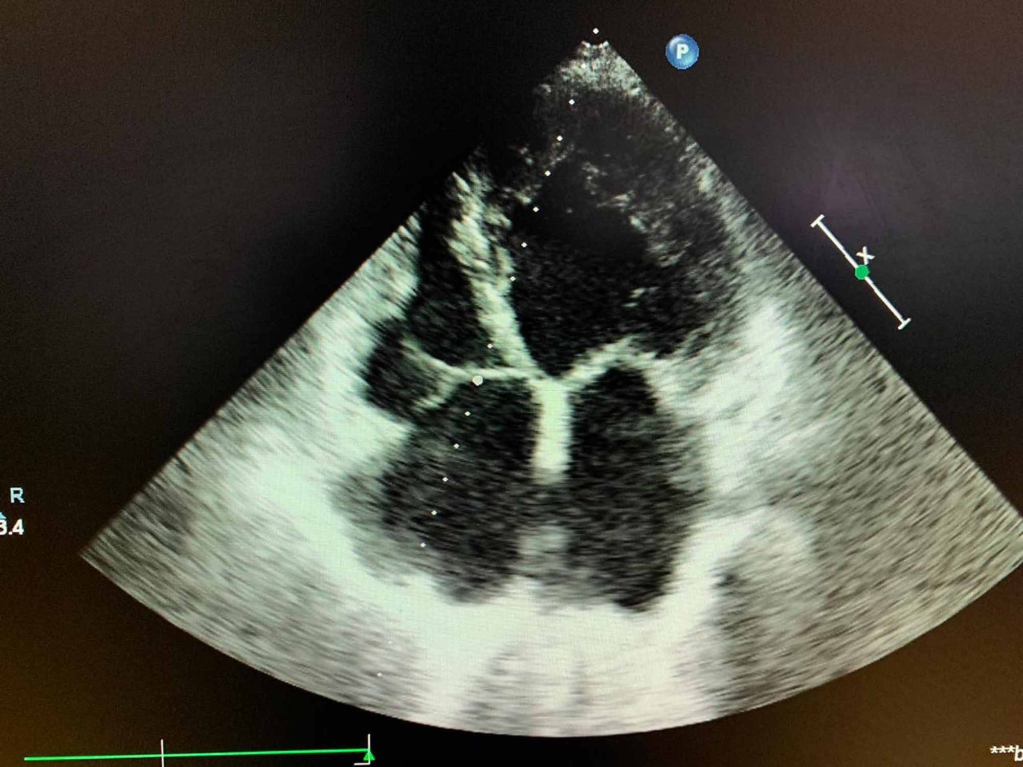 Cureus A Case of Hemolytic Anemia With Acute Myocarditis and