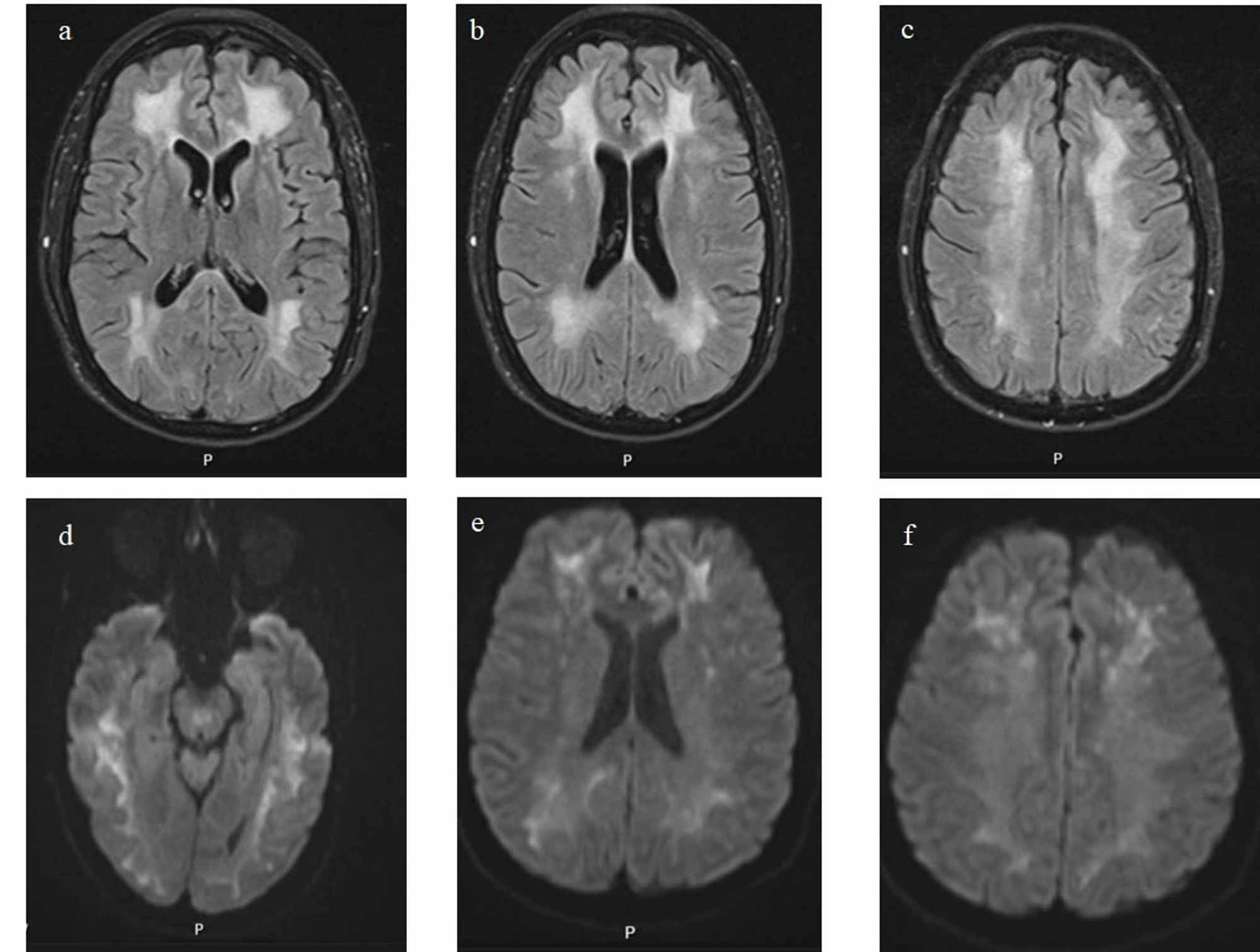 Cureus | Mimicking a Psychiatric Disorder: Heroin-Induced ...