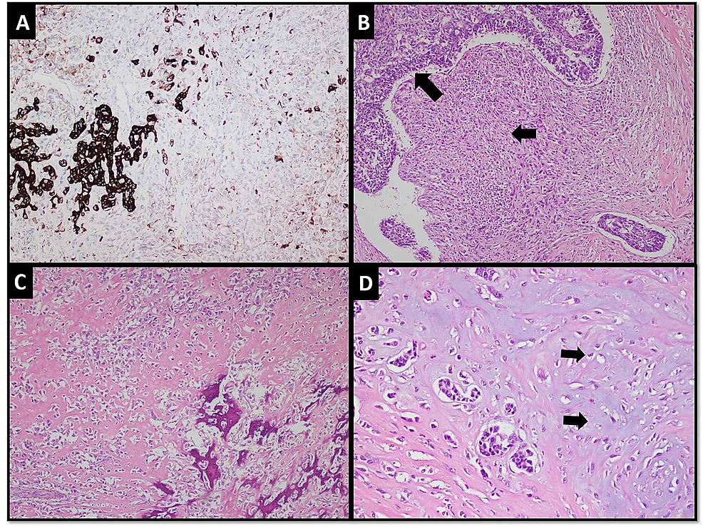 Cureus | Malignant Eccrine Adenoma With Sarcomatous (Heterologous ...