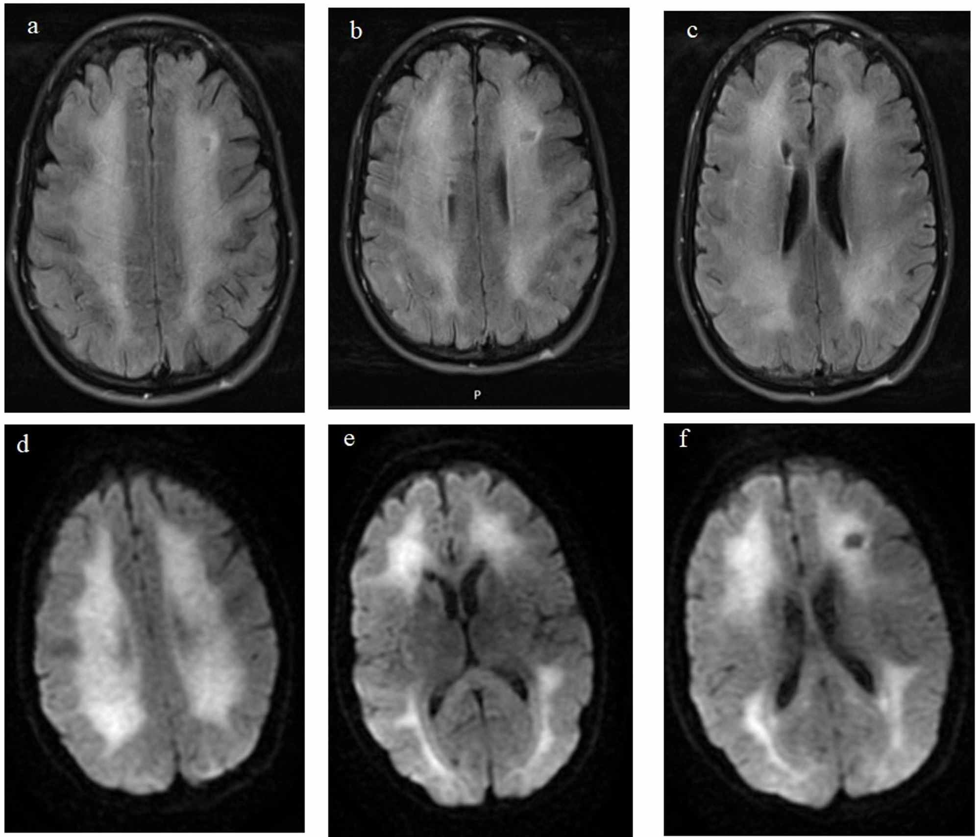 Cureus | Mimicking a Psychiatric Disorder: Heroin-Induced ...