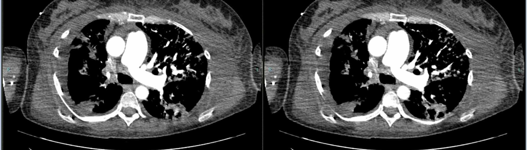 Cureus | Pulmonary Tumor Embolism: A Rare Cause of Acute Pulmonary ...