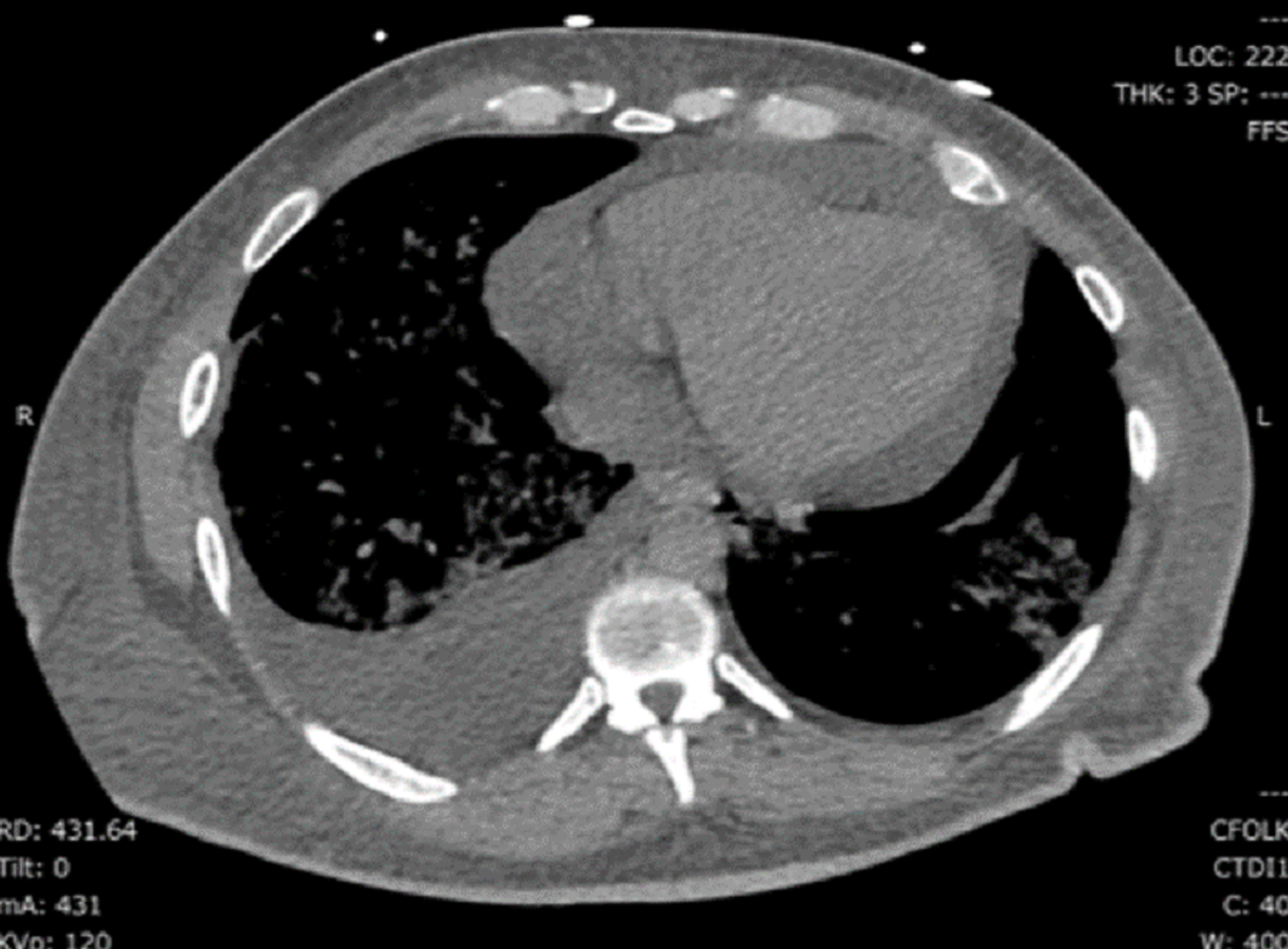 Cureus A Rare Case Of Covid 19 Myocarditis With Cardiac Tamponade In A Young Diabetic Adult With Renal Failure