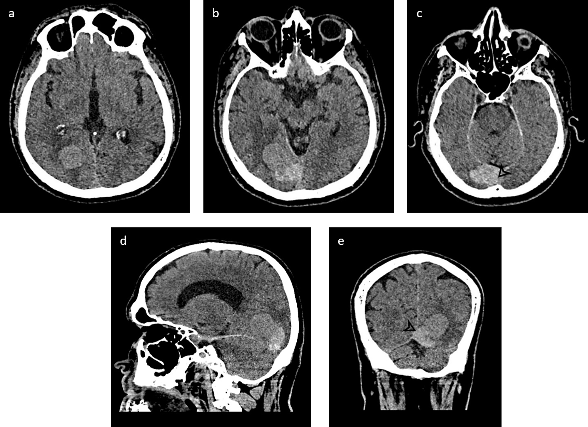 Cureus Grade III Solitary Fibrous Tumor/Hemangiopericytoma A Rare