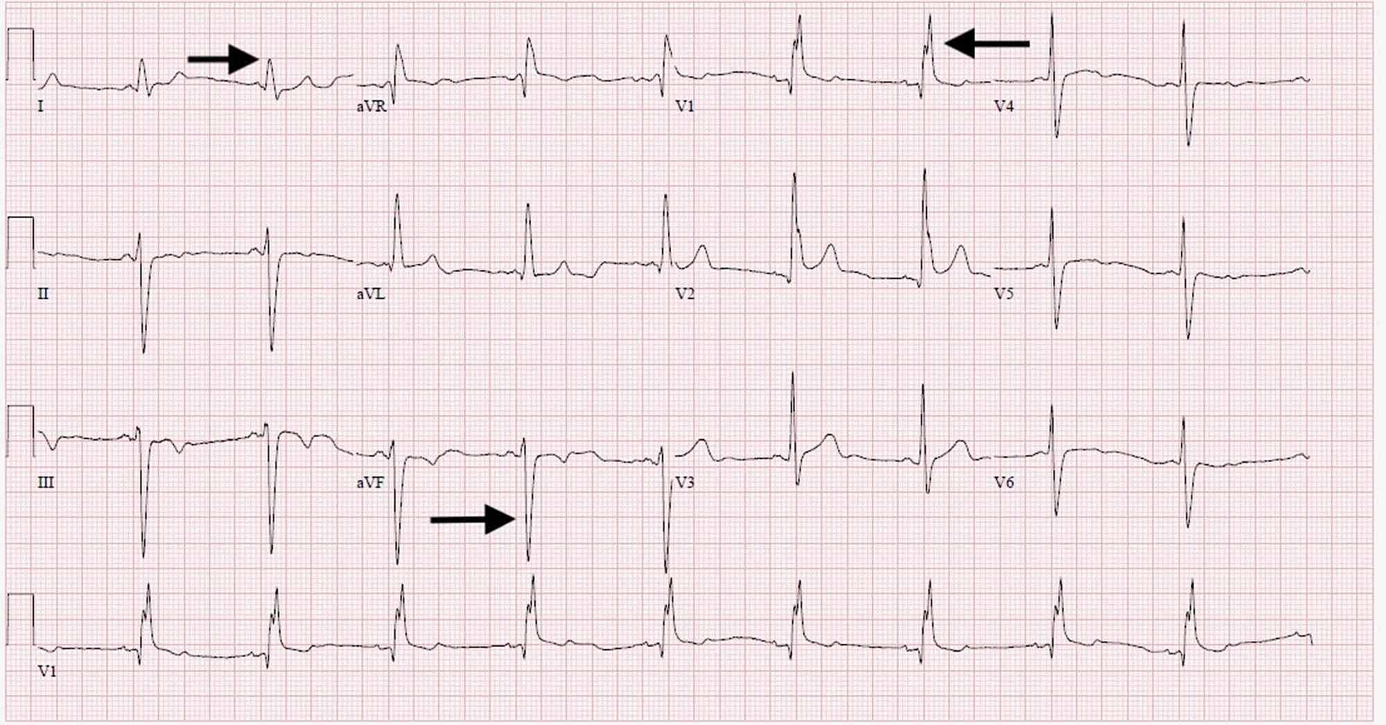 Cureus | Heerfordt-Waldenström Syndrome Manifesting as Cardiac Sarcoidosis